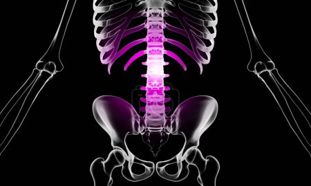 Téléchargez les photos : Illustration médicale 3D de lésion lombaire de la colonne vertébrale aux rayons X - en image libre de droit