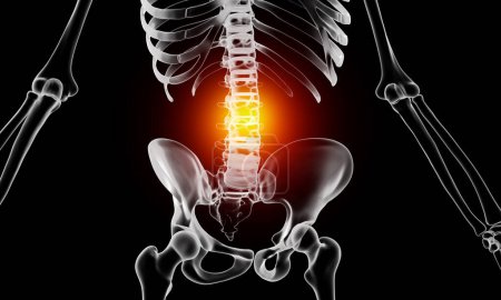 Téléchargez les photos : Lésion vertébrale lombaire discale sur squelette humain illustration médicale - en image libre de droit