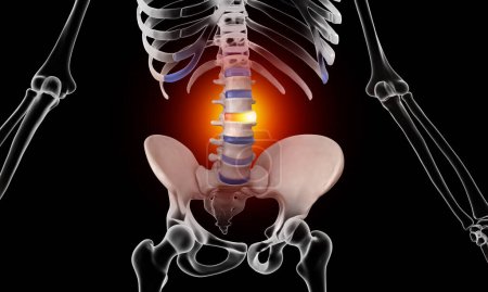 Lesión lumbar discal abultada en el esqueleto humano ilustración médica