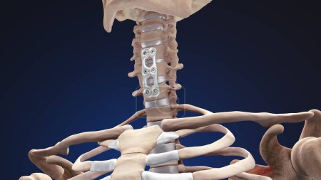 Orthopädische Wirbelsäulenfixierung Spinal Fixator vordere Halsplatte