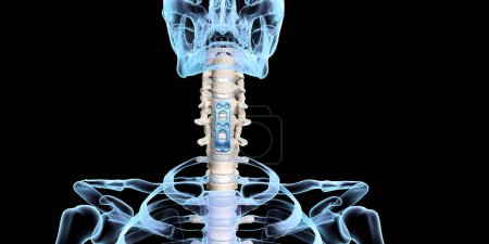 Photo for Orthopedic Spine Fixation Spinal Fixator Anterior Cervical Plate - Royalty Free Image