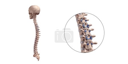 Foto de Ilustración médica 3D de la fusión torácica posterior de la columna vertebral con tornillos y varillas de pedículo en el esqueleto humano - Imagen libre de derechos