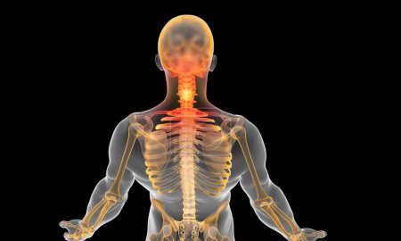 esqueleto humano con dolor en la región cervical de la columna vertebral