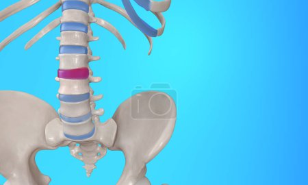 Bulging disc spinal injury skeleton medical illustration