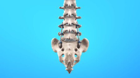 Foto de Ilustración médica de la fusión lumbar posterior de la columna vertebral con tornillos y varillas de pedículo - Imagen libre de derechos