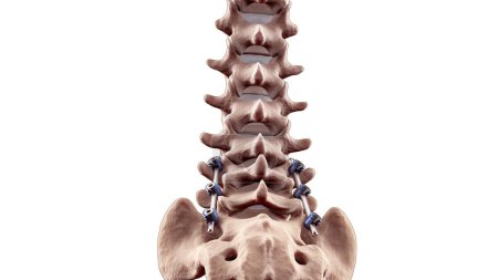 Foto de Ilustración médica de la fusión lumbar posterior de la columna vertebral con tornillos y varillas de pedículo - Imagen libre de derechos