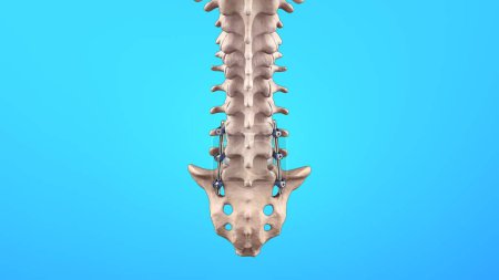 Ilustración médica de la fusión lumbar posterior de la columna vertebral con tornillos y varillas de pedículo