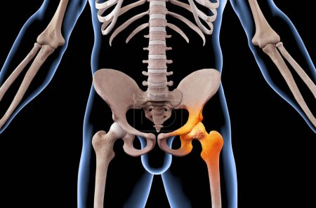 Foto de Ilustración médica 3D del esqueleto humano con la lesión de la articulación de la cadera de la osteoartritis - Imagen libre de derechos