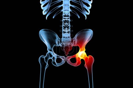 Foto de Ilustración médica 3D del esqueleto humano con la lesión de la articulación de la cadera de la osteoartritis - Imagen libre de derechos