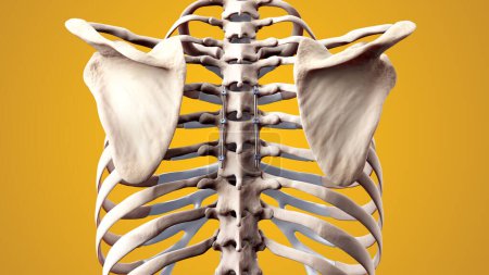 Foto de Ilustración médica 3D de la fusión torácica posterior de la columna vertebral con tornillos y varillas de pedículo en el esqueleto humano - Imagen libre de derechos