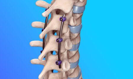 Fusión torácica posterior de la columna vertebral con tornillos y varillas de pedículo sobre fondo azul