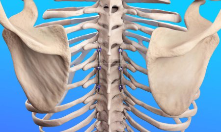 Photo for 3D Medical Illustration of Spine Posterior Thoracic Fusion with Pedicle Screws and Rods on Human Skeleton - Royalty Free Image