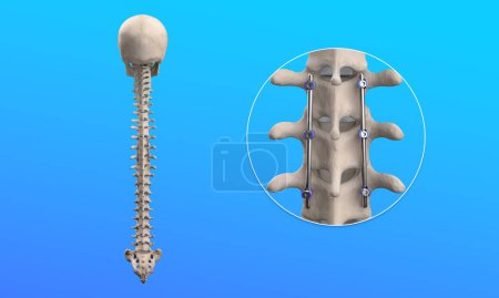 Photo for 3D Medical Illustration of Spine Posterior Thoracic Fusion with Pedicle Screws and Rods on Human Skeleton - Royalty Free Image
