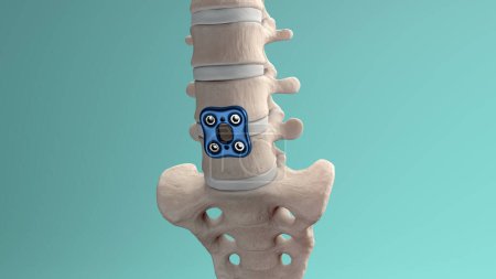 Ilustración médica 3D de la fijación ortopédica de la columna Fijador de columna Placa lumbar anterior