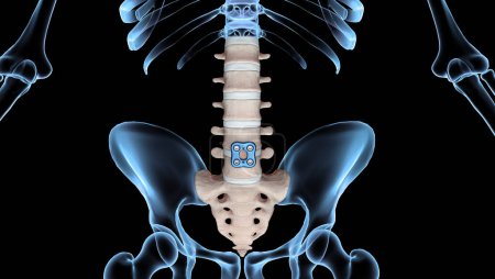 3D Medical Illustration of Orthopedic Spine Fixation Spinal Fixator Anterior Lumbar Plate