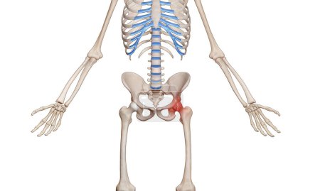 Photo for Medical illustration of human male skeleton with osteoarthritis hip joint injury on femur and pelvic joint - Royalty Free Image