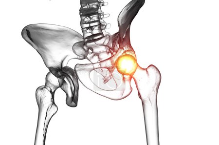 Medizinische Illustration des menschlichen männlichen Skeletts mit Arthrose Hüftgelenkverletzung am Oberschenkel- und Beckengelenk