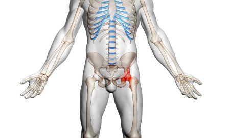 Foto de Ilustración médica del esqueleto masculino humano con osteoartritis lesión articular de cadera en fémur y articulación pélvica - Imagen libre de derechos