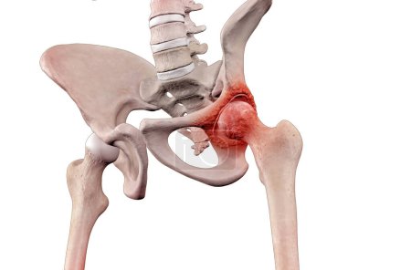Medical illustration of human male skeleton with osteoarthritis hip joint injury on femur and pelvic joint