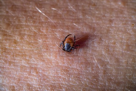 Photo for Macrophoto of a tick that has bitten a person - Royalty Free Image