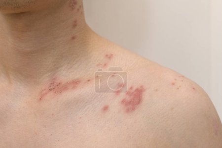 Photo for Close up of man with shingles disease on skin - Royalty Free Image
