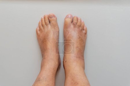 Swollen foot, ankle and leg