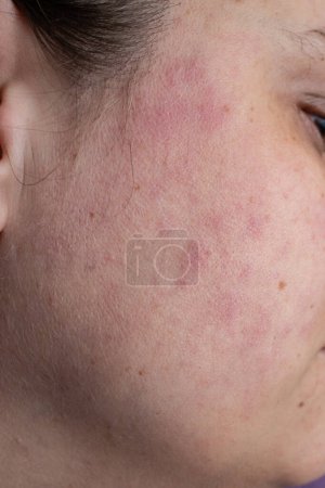 Téléchargez les photos : Éruption cutanée rouge sur le visage d'une femme due à une maladie vivante, gros plan - en image libre de droit