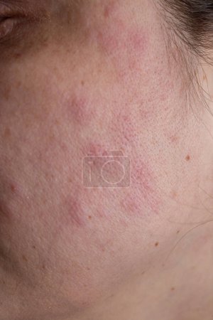 Téléchargez les photos : Éruption cutanée rouge eczéma sur le visage d'une femme en raison d'une maladie du foie gras, gros plan - en image libre de droit