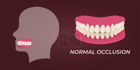 Malokklusion menschlicher Zähne mit realistischen Bildern von Mundkiefern mit schiefen Zähnen und Textunterschriften. Normale und abnorme Okklusion. Vektorillustration