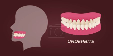Ilustración de Maloclusión de dientes humanos con imágenes realistas de mandíbulas bucales con dientes torcidos y leyendas de texto. Oclusión normal y anormal. Ilustración vectorial - Imagen libre de derechos