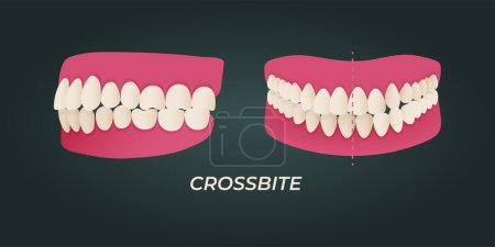 Malokklusion menschlicher Zähne mit realistischen Bildern von Mundkiefern mit schiefen Zähnen und Textunterschriften. Normale und abnorme Okklusion. Vektorillustration