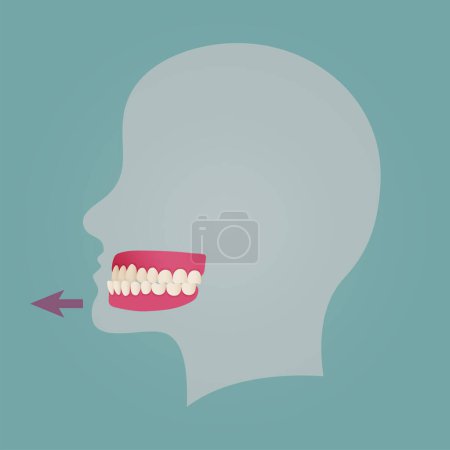 Téléchargez les illustrations : Human teeth malocclusion set with realistic images of mouth jaws with crooked teeth and text captions. Normal and abnormal occlusion. Vector illustration - en licence libre de droit