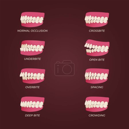Illustration for Human teeth malocclusion set with realistic images of mouth jaws with crooked teeth and text captions. Normal and abnormal occlusion. Vector illustration - Royalty Free Image