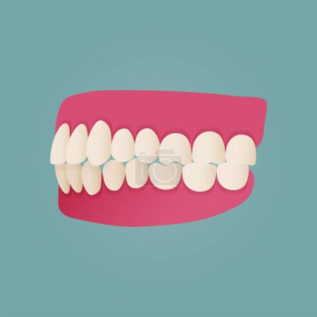 Ilustración de Maloclusión de dientes humanos con imágenes realistas de mandíbulas bucales con dientes torcidos y leyendas de texto. Oclusión normal y anormal. Ilustración vectorial - Imagen libre de derechos