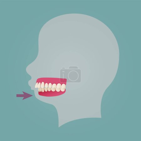 Téléchargez les illustrations : Human teeth malocclusion set with realistic images of mouth jaws with crooked teeth and text captions. Normal and abnormal occlusion. Vector illustration - en licence libre de droit