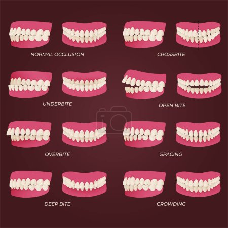Maloclusión de dientes humanos con imágenes realistas de mandíbulas bucales con dientes torcidos y leyendas de texto. Oclusión normal y anormal. Ilustración vectorial