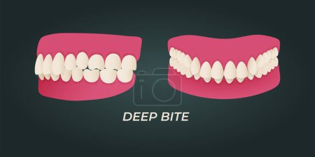 Ilustración de Human teeth malocclusion set with realistic images of mouth jaws with crooked teeth and text captions. Normal and abnormal occlusion. Vector illustration - Imagen libre de derechos