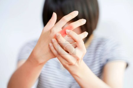 Foto de Inflamación de las articulaciones de los dedos de las mujeres, artritis reumatoide (psoriasis) a menudo viene con muchos síntomas en muchas articulaciones. - Imagen libre de derechos