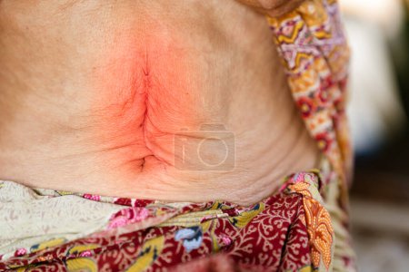 Photo for Abdominoplasty scars of an elderly woman with abdominal disease problems such as gastritis or inflammatory bowel disease. - Royalty Free Image