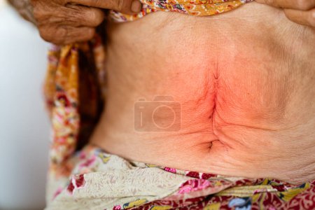 Photo for Abdominal surgery wounds of elderly patients with gastritis or abdominal disease. - Royalty Free Image