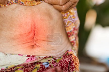 Photo for Abdominal surgery wounds of elderly patients with gastritis or abdominal disease. - Royalty Free Image