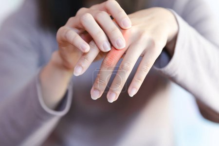 Foto de La mujer tiene dolor en las articulaciones de los dedos debido a la artritis reumatoide. Concepto de salud. - Imagen libre de derechos