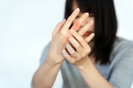 Foto de La mujer tiene dolor en las articulaciones de los dedos debido a la artritis reumatoide. Concepto de salud. - Imagen libre de derechos