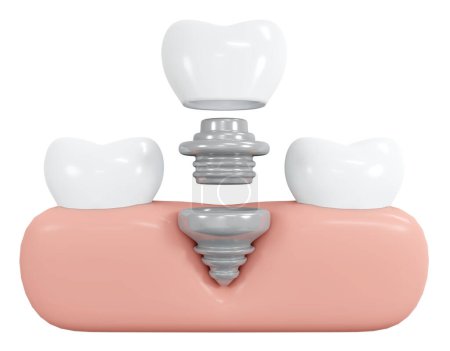 Téléchargez les photos : 3D Rendering teeth with implant with gum tool icon cartoon style isolated on white. 3D Render illustration. - en image libre de droit