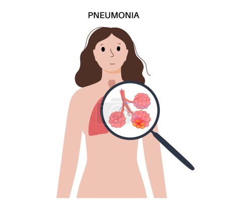Illustration for Pneumonia infection anatomical poster. Inflammation in the human respiratory system. Disease in lungs, purulent material in chest. Viruses, bacteria in human body. Flat vector illustration for clinic - Royalty Free Image