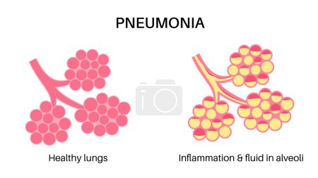 Illustration for Pneumonia infection anatomical poster. Inflammation in the human respiratory system. Alveoli with fluid. Disease in lungs, purulent material in chest. Difficult breathing and cough vector illustration - Royalty Free Image