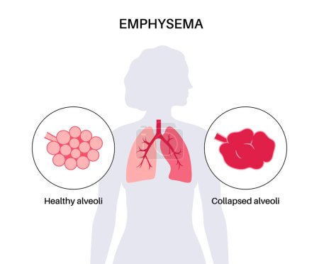 Emphysema-Konzept. Beschädigte Lungenbläschen, Versagen der Atemwege. Schlappe Wände zwischen Luftsäcken in menschlichen Lungen. Atemnot, Engegefühl in der Brust. Erkrankung des Atmungssystems Abbildung des flachen Vektors