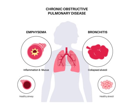 Illustration for Chronic obstructive pulmonary disease or COPD. Group of lung disease. Problem with airways and air sacs, mucus in lungs, collapsed alveoli. Illness of human respiratory system flat vector illustration - Royalty Free Image