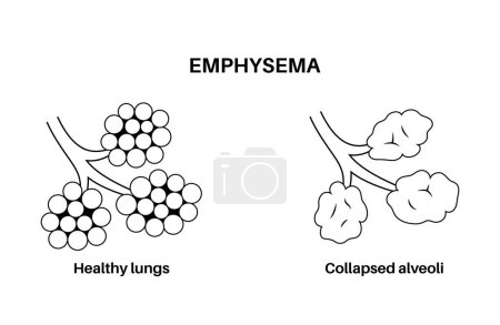 Illustration for Emphysema disease concept. Damaged alveoli, failure airway. Floppy walls between air sacs in human lungs. Shortness of breath, chest tightness. Illness of respiratory system flat vector illustration - Royalty Free Image