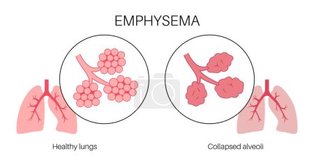 Emphysema disease concept. Damaged alveoli, failure airway. Floppy walls between air sacs in human lungs. Shortness of breath, chest tightness. Illness of respiratory system flat vector illustration